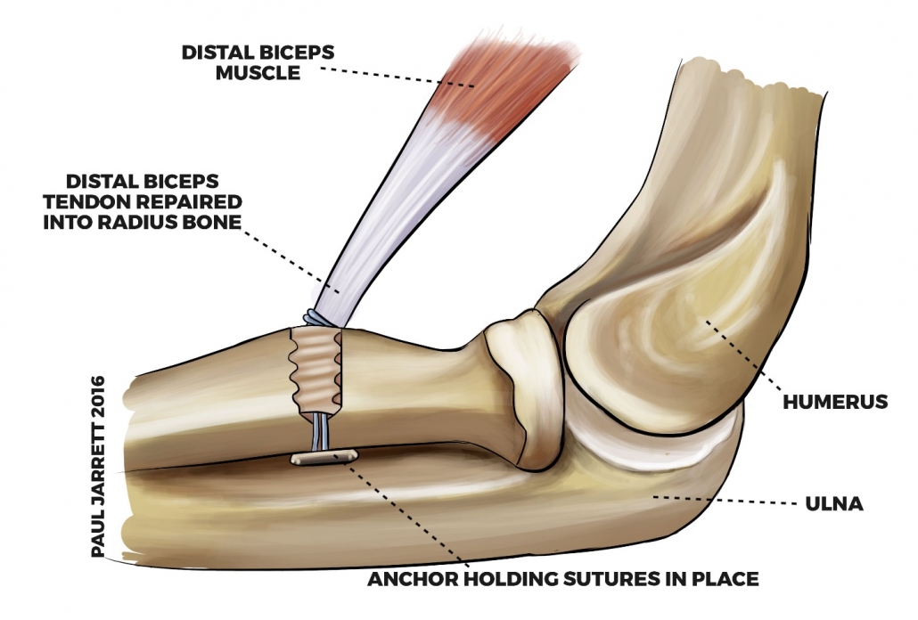 Biceps Tendon Tear At The Elbow Dr Groh