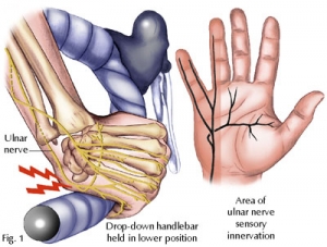 Ulnar Nerve Entrapment At The Wrist Dr Groh