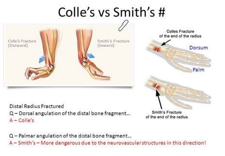 colles fracture treatment