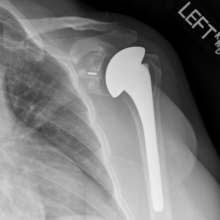 Standard (Anatomic) Total Shoulder Replacement | Dr. Gordon Groh