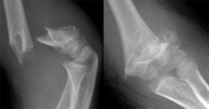 Distal Humerus Fractures Of The Elbow Dr Groh My Xxx Hot Girl