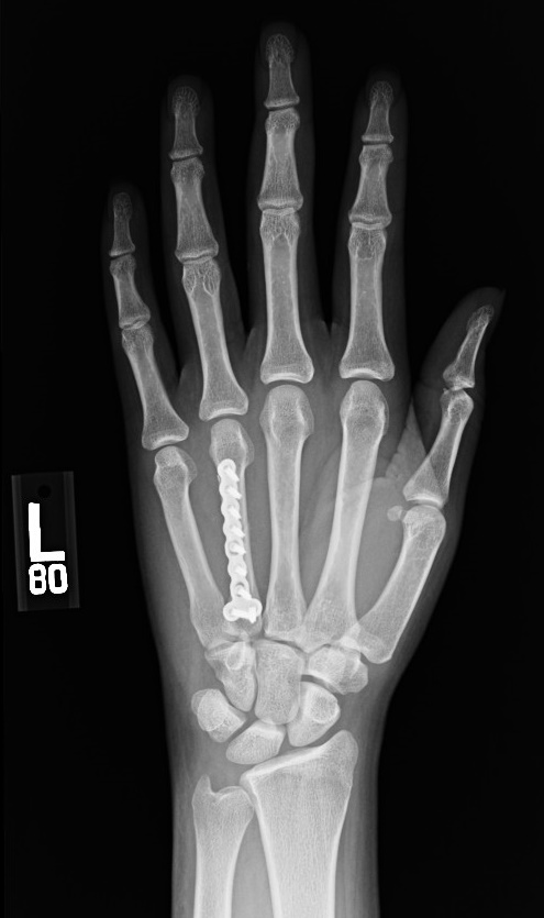 broken hand bones xray