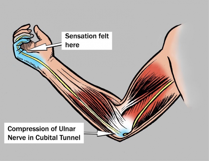 ulnar-nerve-entrapment-at-the-elbow-dr-groh