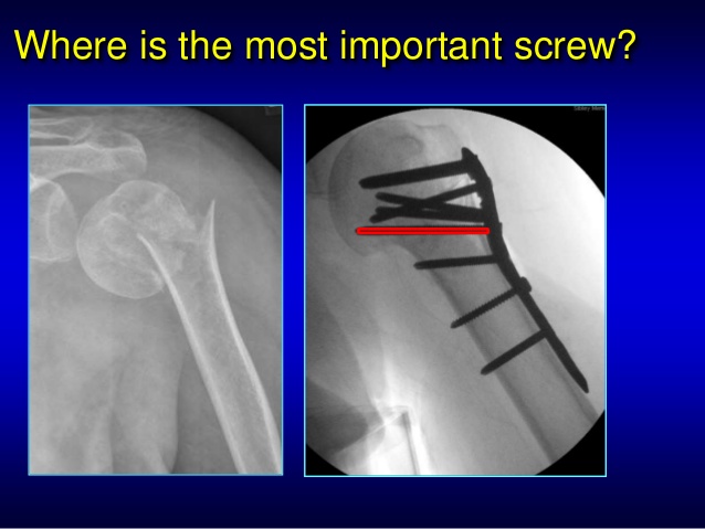 comminuted proximal humerus fracture