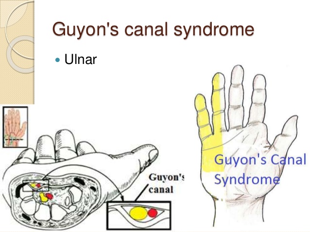 Cubital tunnel syndrome (ulnar nerve compression neuropathy)