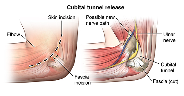 Cubital Tunnel Syndrome (Ulnar Nerve Entrapment)  Lancaster Orthopedic  Group, Lancaster County, PA - Lancaster Orthopedic Group