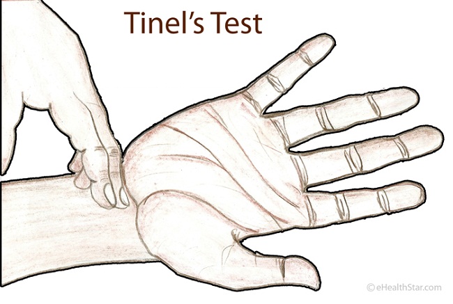 Ulnar Nerve Palsy, Claw Hand & Wrist Pain Treatment