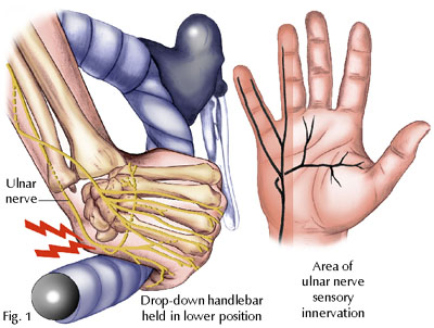 ulnar nerve entrapment wrist