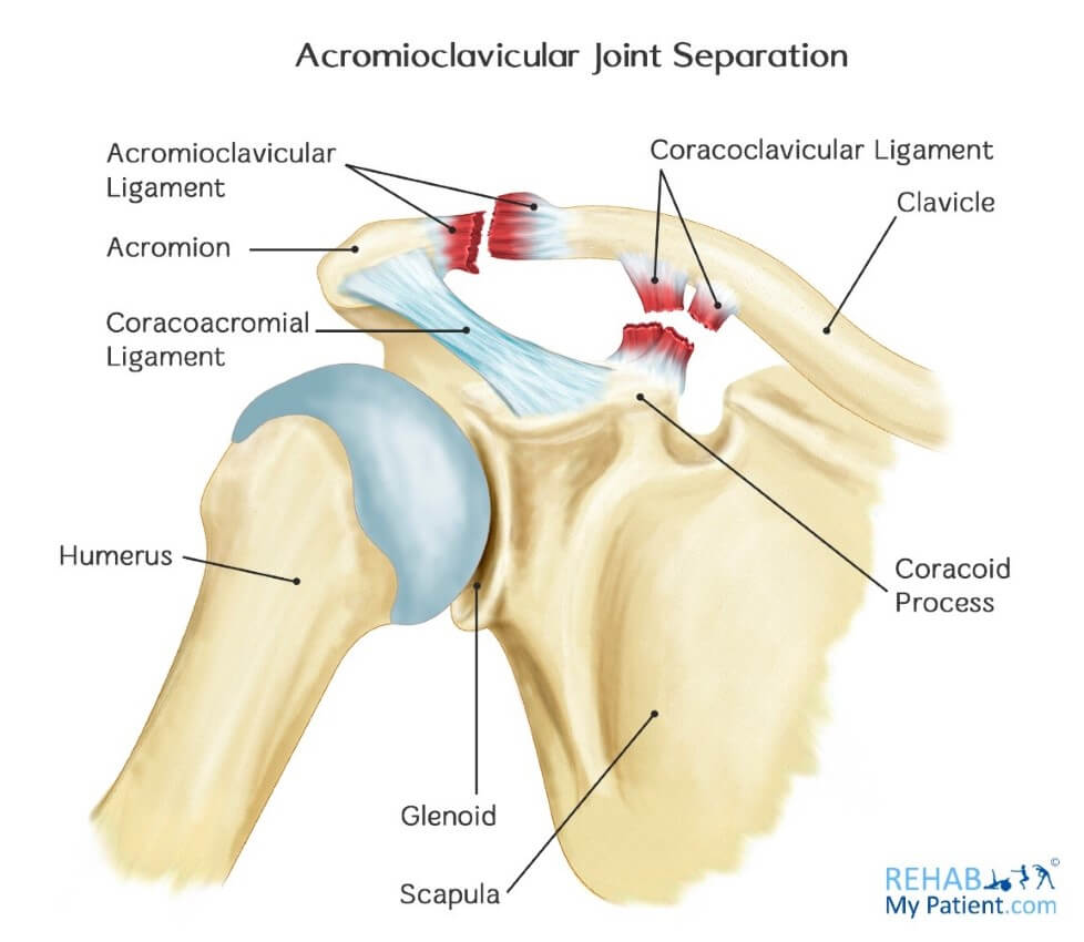 Shoulder Separation Dr Groh