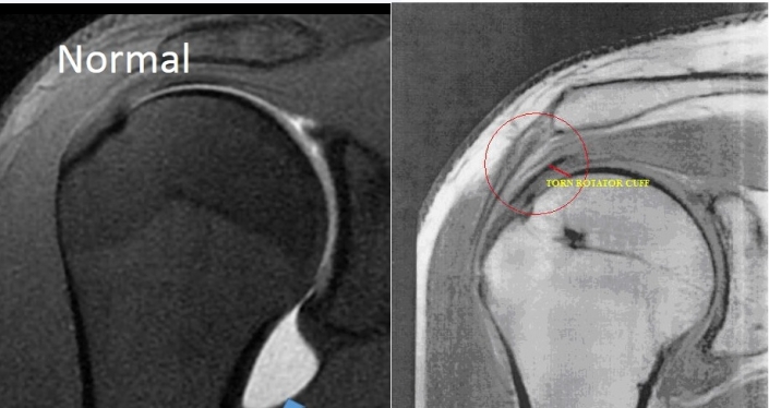 Shoulder Impingement MRI