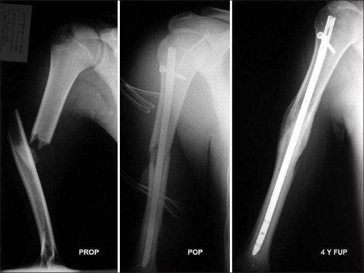 Upper Arm (Humeral Shaft) Fractures - Dr. Groh